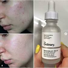 The Ordinary Niacinamide 10% + Zinc 1% – 30ml Anglic